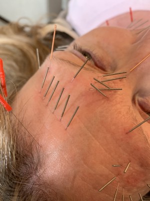 Acupuncture 2.jpg