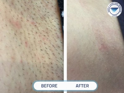 Ingrown (bikini ) laser hair removal result.JPG